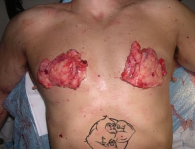 Gyno from steroids pictures