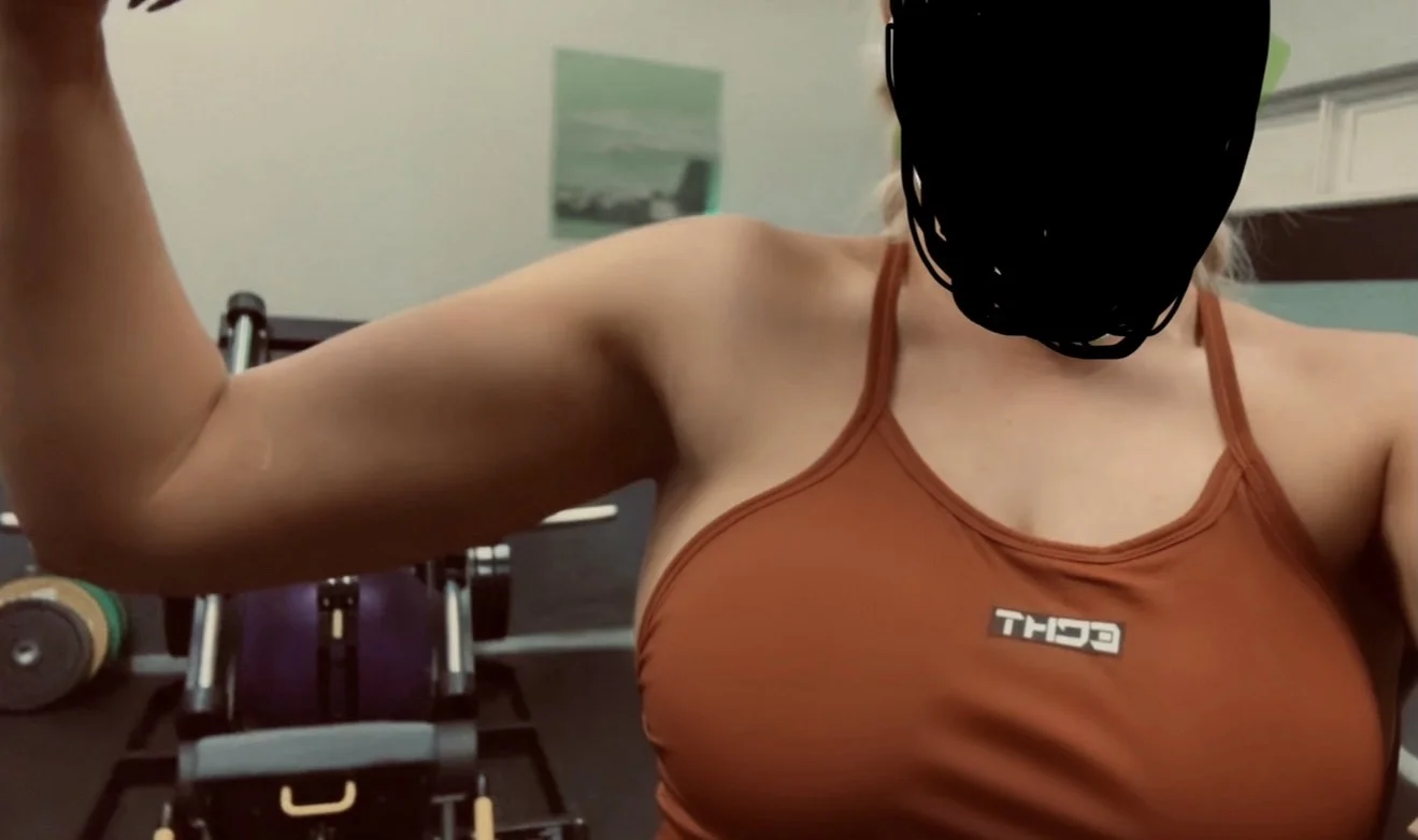 bicep lump 2.webp