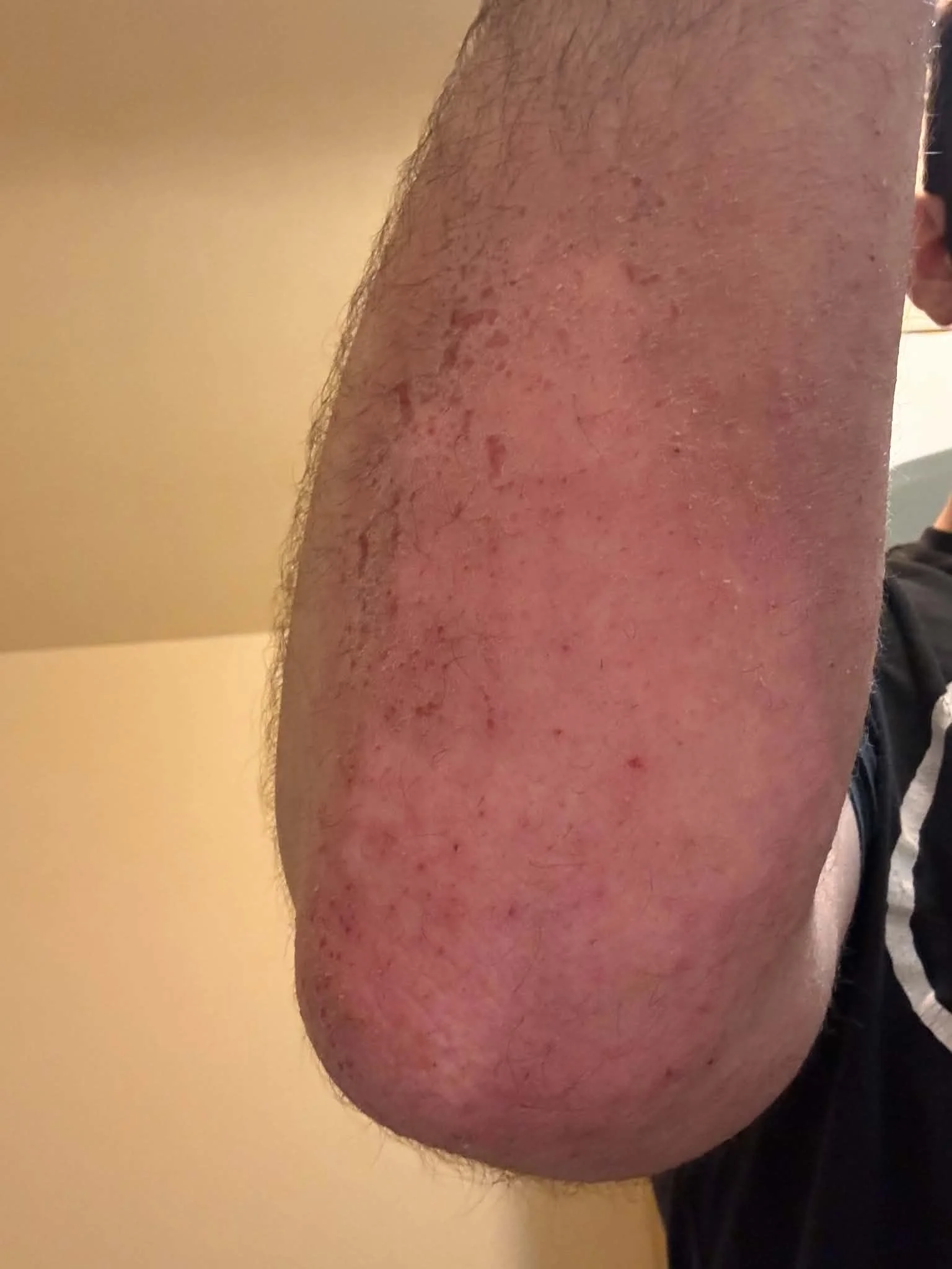 healing_elbow.webp