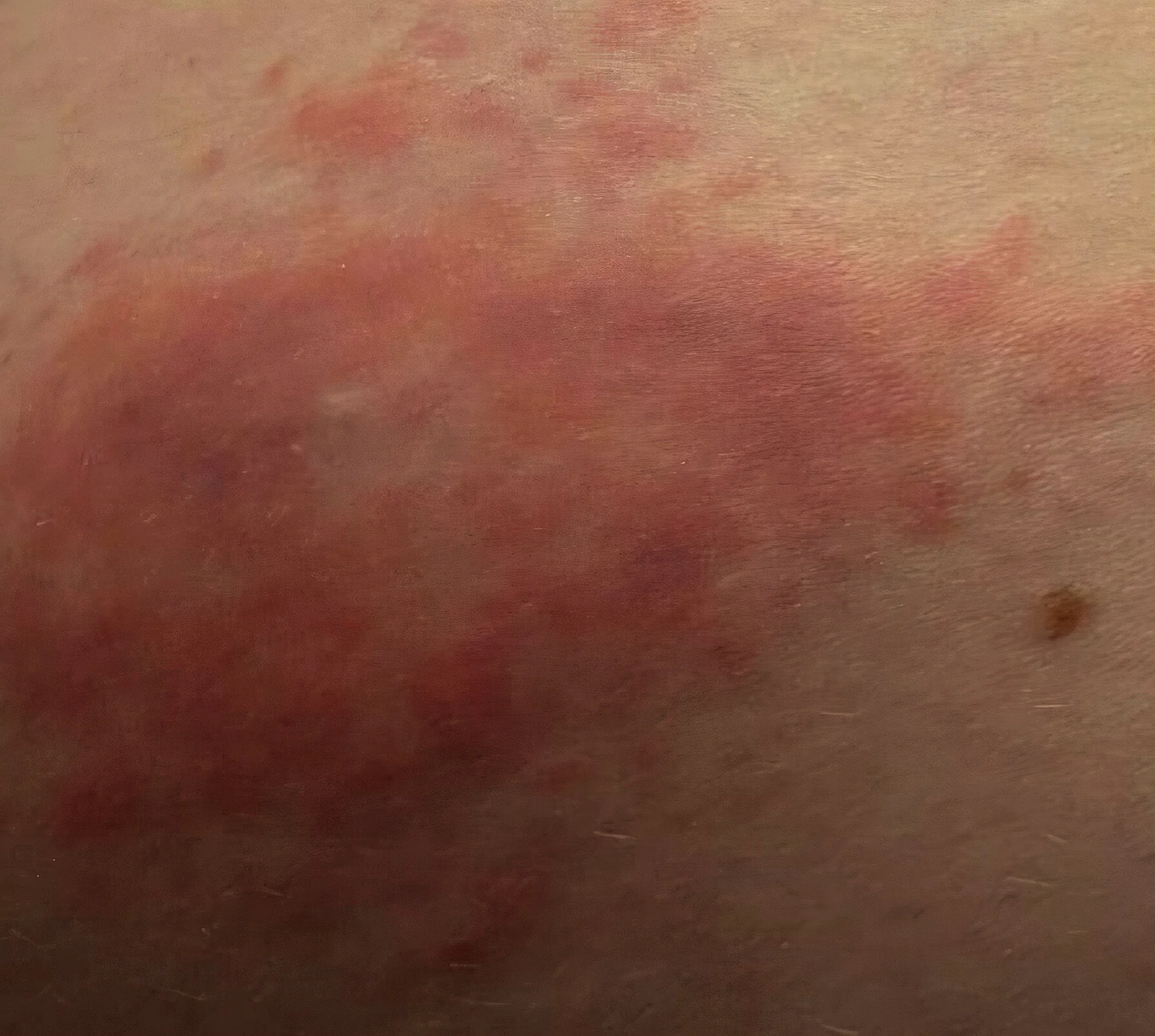 rash.webp