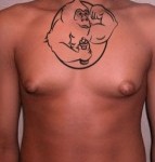 gynecomastia chest