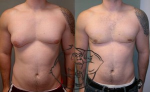 gynecomastia