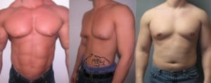 types-of-gynecomastia-300x118.jpg