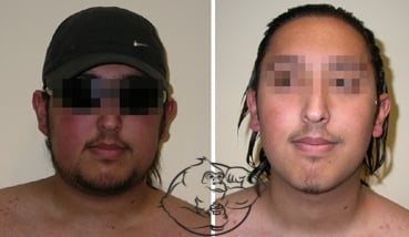 moon face steroids comparison