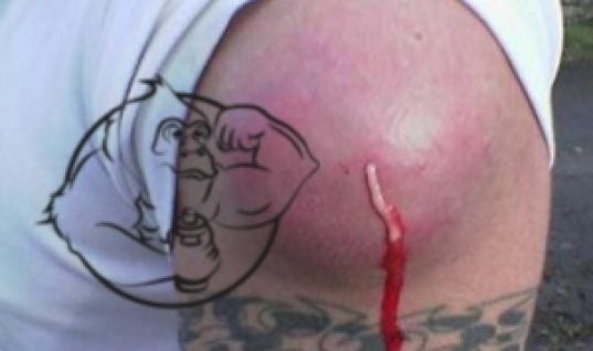 abscess deltoid injection
