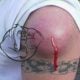 abscess deltoid injection