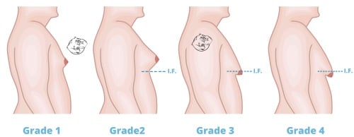 stages of gynecomastia