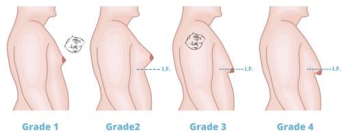 stages-of-gynecomastia.jpg