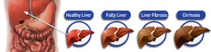 liver-damage