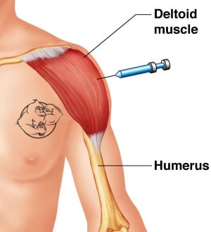Deltoid injections (shoulder)