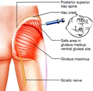 Gluteus injection