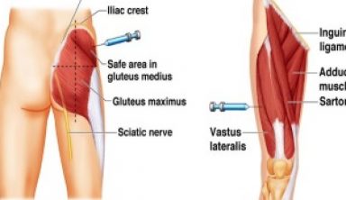 Quadricep injection