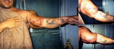 Gregg Valentino bicep injury