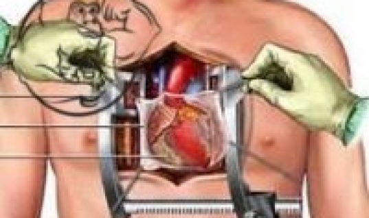 CT Fletcher open heart surgery