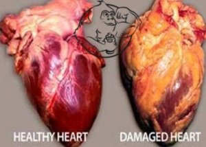 HEART DISEASE