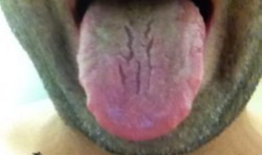 end of day 3 pictures of tongue