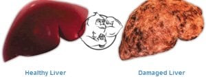 liver-damage