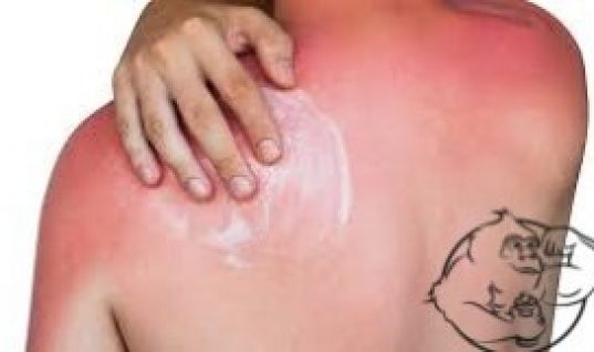 sunburn cure