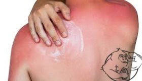 sunburn cure