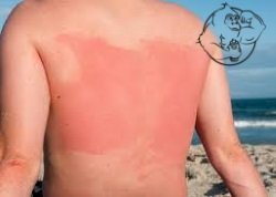 sunburn