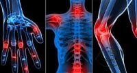 joint inflammation